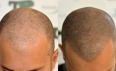 Costo tricopigmentazione Milano